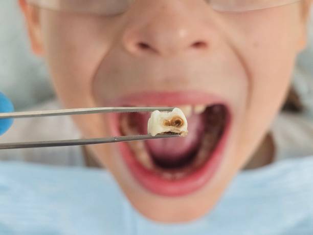 Best Emergency Dental Care for Broken or Chipped Teeth in St Francis, KS